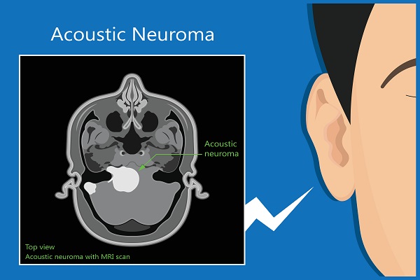 What Is Acoustic Neuroma?