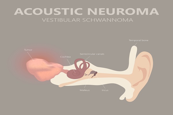 How Serious Is An Acoustic Neuroma