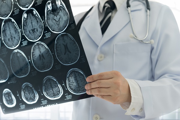 How A Neurosurgeon Treats A Brain Aneurysm